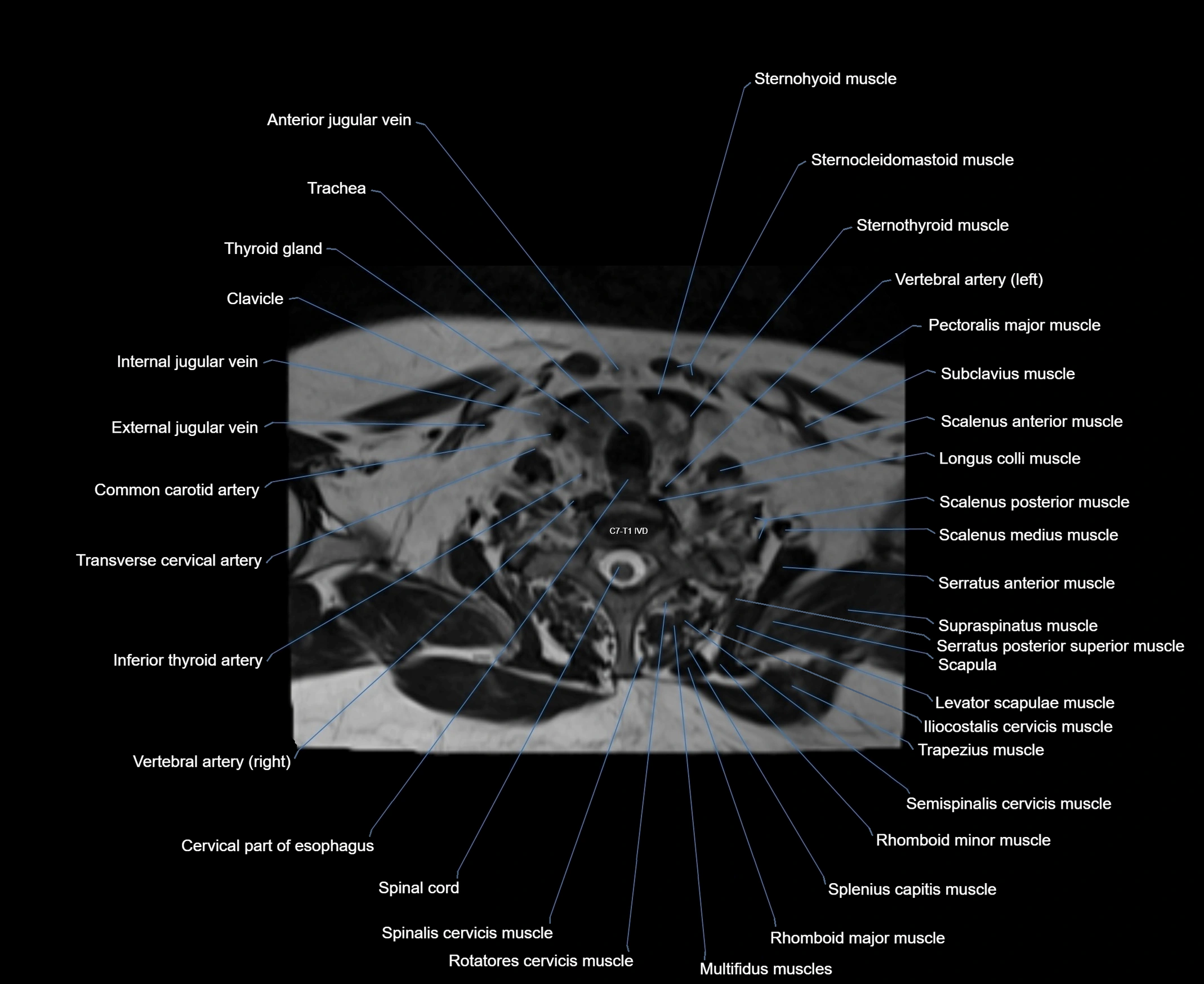 MRI Neck 3D labelled cross section anatomy axial 3t image-00001-00081.webp